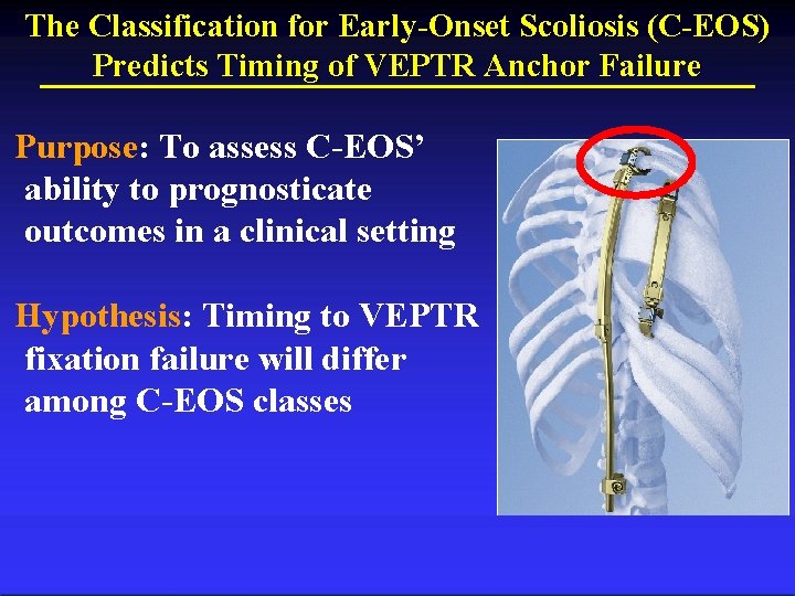 The Classification for Early-Onset Scoliosis (C-EOS) Predicts Timing of VEPTR Anchor Failure Purpose: To