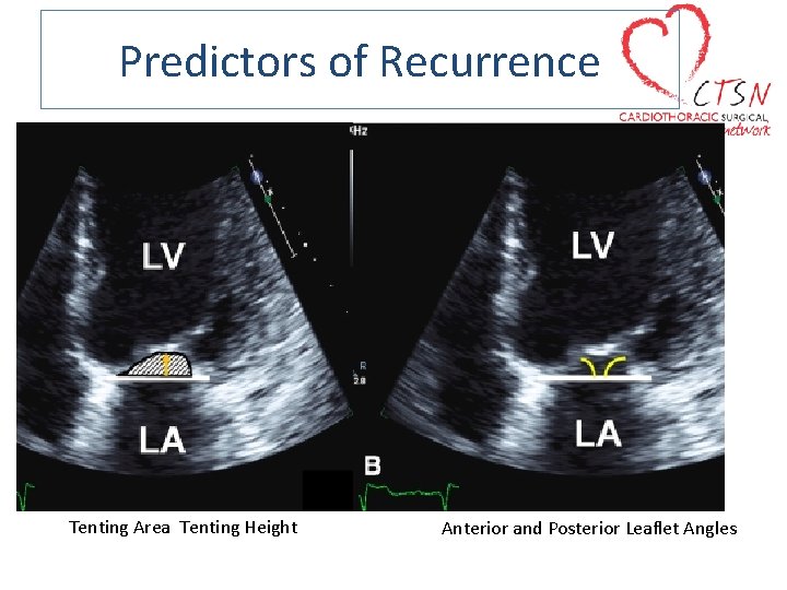 Predictors of Recurrence Tenting Area Tenting Height Anterior and Posterior Leaflet Angles 