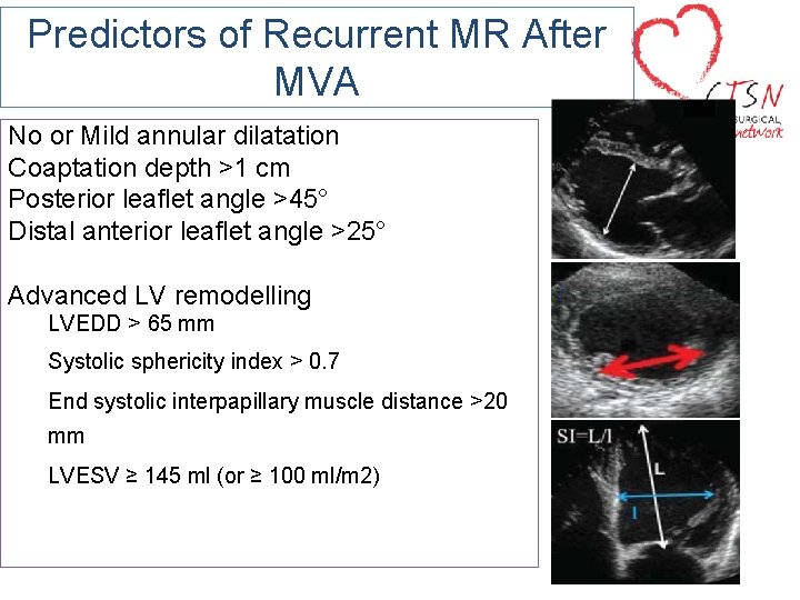 Predictors of Recurrent MR After MVA No or Mild annular dilatation Coaptation depth >1