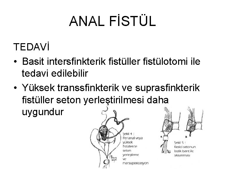 ANAL FİSTÜL TEDAVİ • Basit intersfinkterik fistüller fistülotomi ile tedavi edilebilir • Yüksek transsfinkterik ANAL FİSTÜL TEDAVİ • Basit intersfinkterik fistüller fistülotomi ile tedavi edilebilir • Yüksek transsfinkterik
