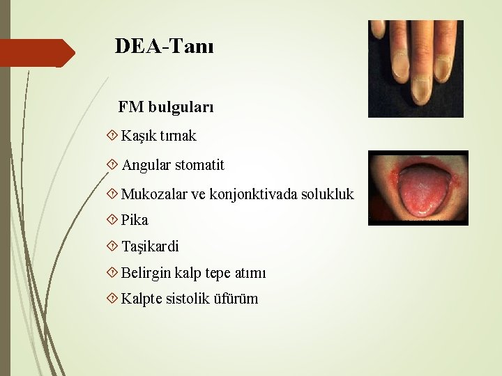 DEA-Tanı FM bulguları Kaşık tırnak Angular stomatit Mukozalar ve konjonktivada solukluk Pika Taşikardi Belirgin