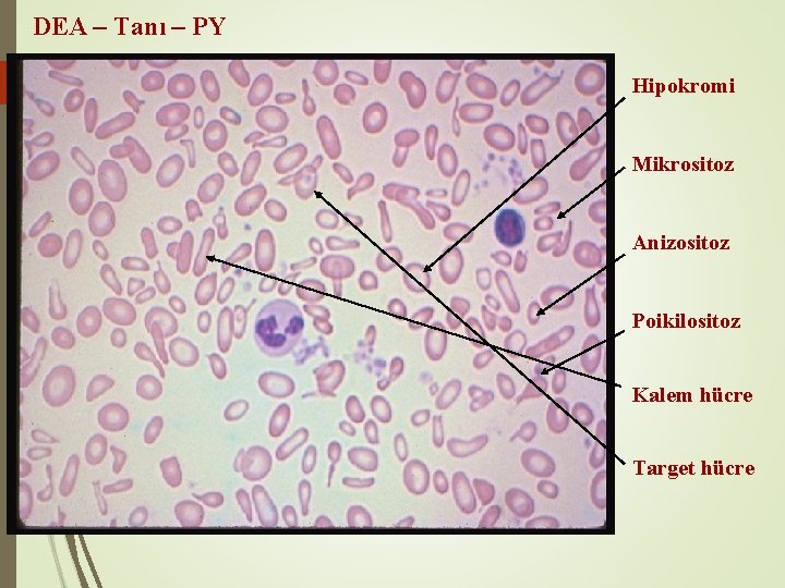 DEA – Tanı – PY Hipokromi Mikrositoz Anizositoz Poikilositoz Kalem hücre Target hücre 