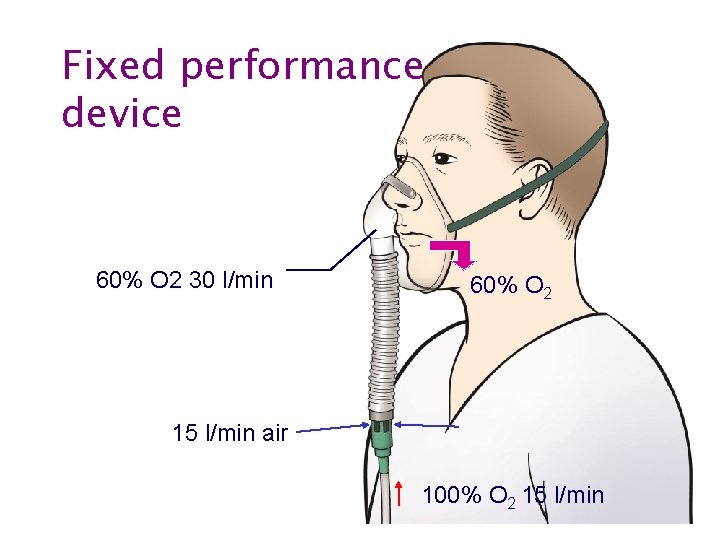 Fixed performance device 60% O 2 30 l/min 60% O 2 15 l/min air