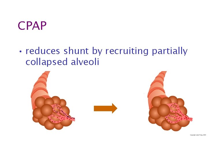 CPAP • reduces shunt by recruiting partially collapsed alveoli 