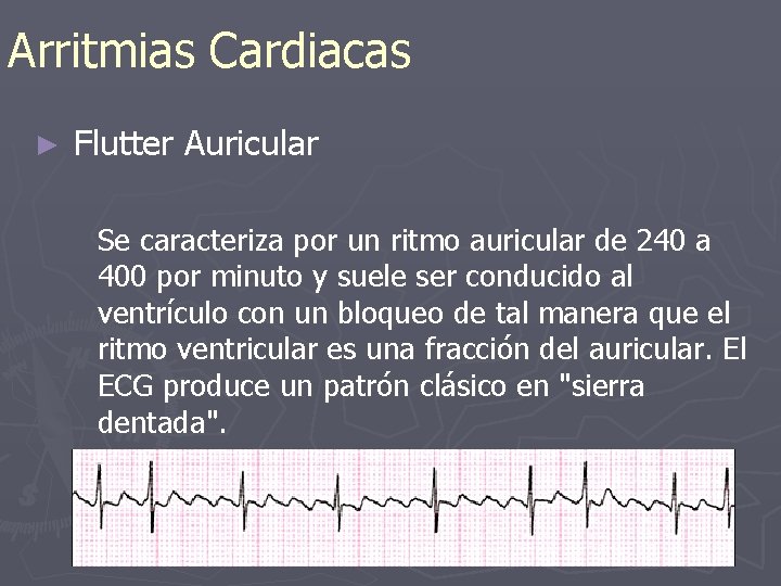 Arritmias Cardiacas ► Flutter Auricular Se caracteriza por un ritmo auricular de 240 a