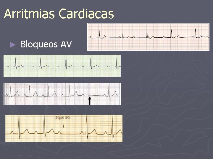 Arritmias Cardiacas ► Bloqueos AV 