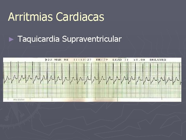 Arritmias Cardiacas ► Taquicardia Supraventricular 