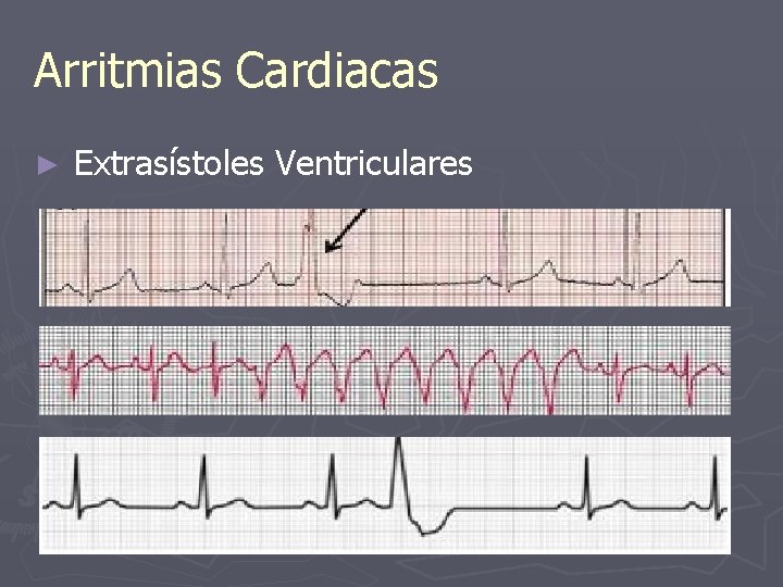 Arritmias Cardiacas ► Extrasístoles Ventriculares 