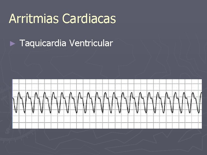 Arritmias Cardiacas ► Taquicardia Ventricular 