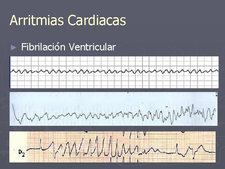 Arritmias Cardiacas ► Fibrilación Ventricular 