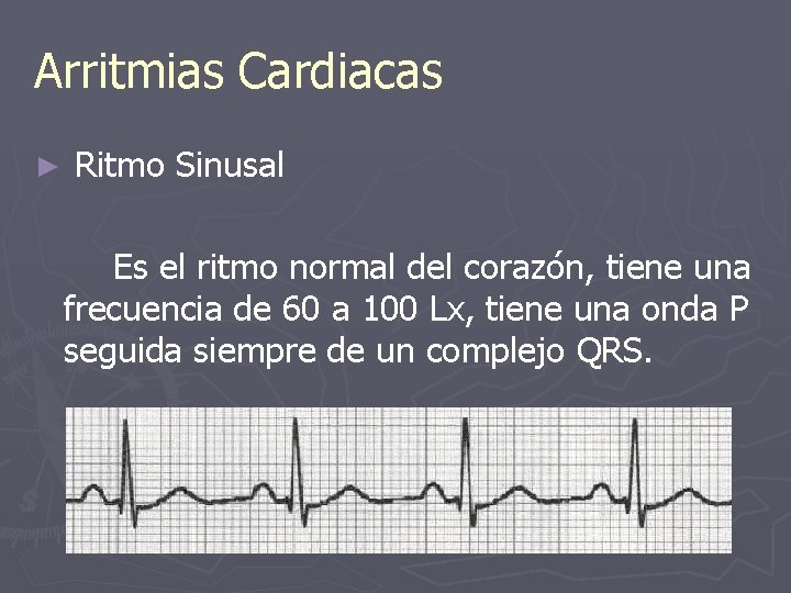 Arritmias Cardiacas ► Ritmo Sinusal Es el ritmo normal del corazón, tiene una frecuencia