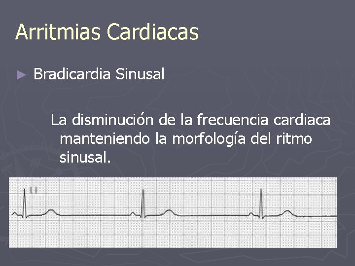 Arritmias Cardiacas ► Bradicardia Sinusal La disminución de la frecuencia cardiaca manteniendo la morfología
