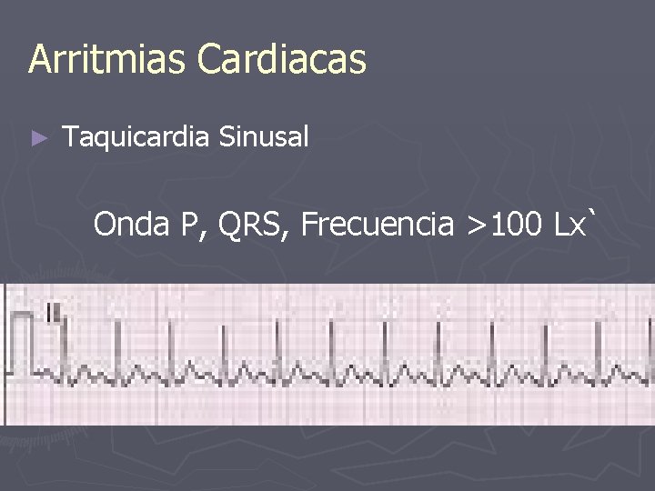 Arritmias Cardiacas ► Taquicardia Sinusal Onda P, QRS, Frecuencia >100 Lx` 