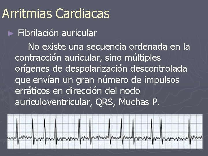 Arritmias Cardiacas ► Fibrilación auricular No existe una secuencia ordenada en la contracción auricular,