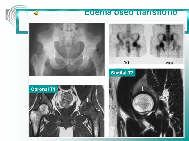 Edema óseo transitorio . . . Sagital T 2 Coronal T 1 . .