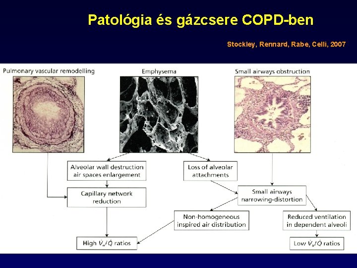 Patológia és gázcsere COPD-ben Stockley, Rennard, Rabe, Celli, 2007 