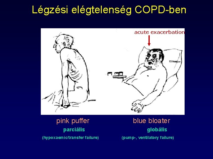 Légzési elégtelenség COPD-ben acute exacerbation pink puffer parciális (hypoxaemic/transfer failure) blue bloater globális (pump-,