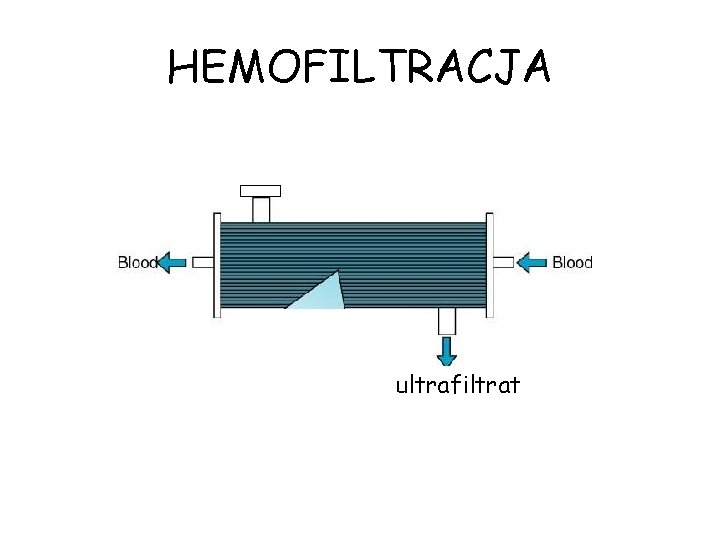 HEMOFILTRACJA ultrafiltrat 