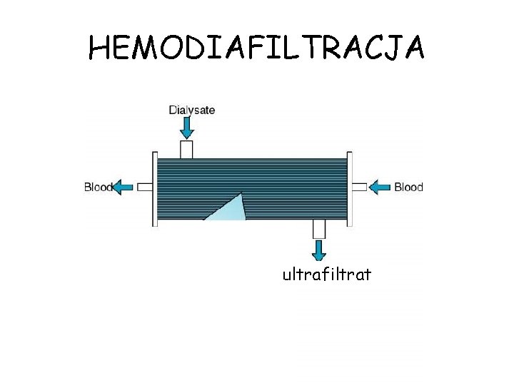 HEMODIAFILTRACJA ultrafiltrat 