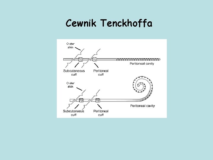 Cewnik Tenckhoffa 