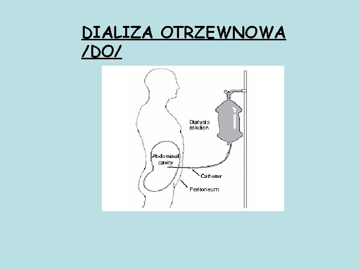 DIALIZA OTRZEWNOWA /DO/ 