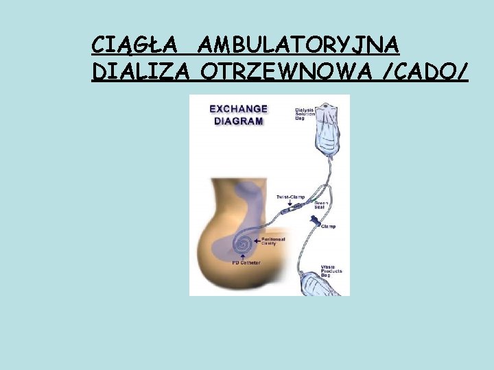 CIĄGŁA AMBULATORYJNA DIALIZA OTRZEWNOWA /CADO/ 