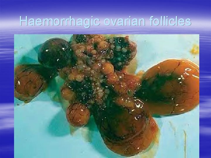 Haemorrhagic ovarian follicles 