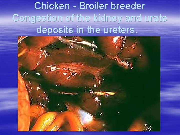 Chicken - Broiler breeder Congestion of the kidney and urate deposits in the ureters.