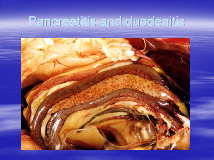 Pancreatitis and duodenitis 