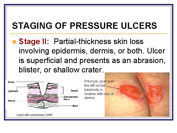 STAGING OF PRESSURE ULCERS n Stage II: Partial-thickness skin loss involving epidermis, or both.