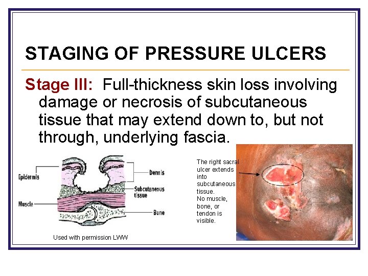STAGING OF PRESSURE ULCERS Stage III: Full-thickness skin loss involving damage or necrosis of