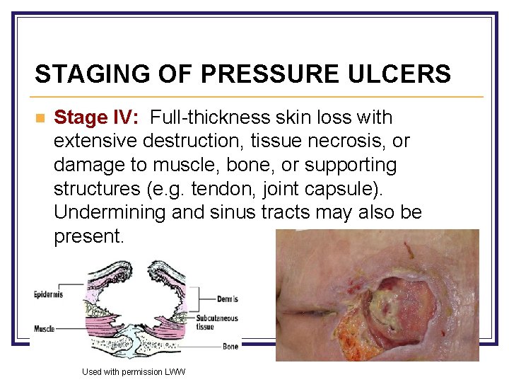 STAGING OF PRESSURE ULCERS n Stage IV: Full-thickness skin loss with extensive destruction, tissue