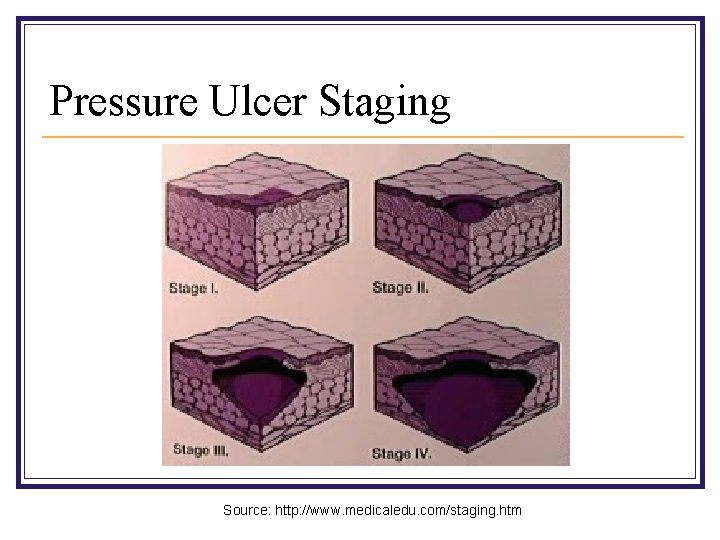 Pressure Ulcer Staging Source: http: //www. medicaledu. com/staging. htm 