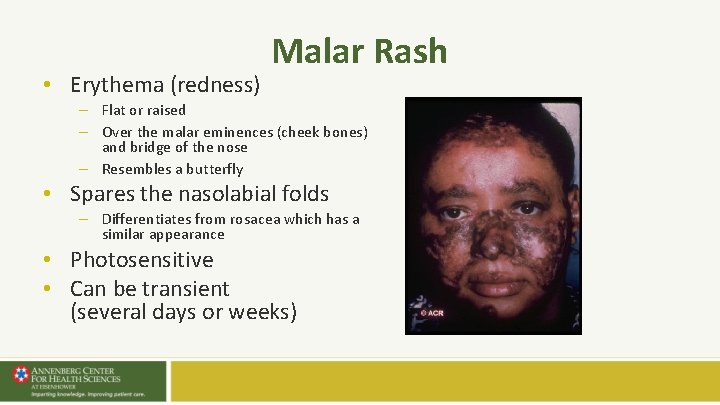 • Erythema (redness) Malar Rash – Flat or raised – Over the malar • Erythema (redness) Malar Rash – Flat or raised – Over the malar