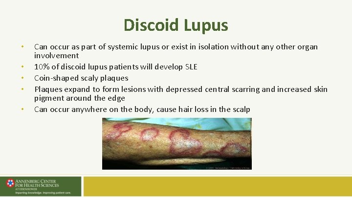 Discoid Lupus • • • Can occur as part of systemic lupus or exist Discoid Lupus • • • Can occur as part of systemic lupus or exist