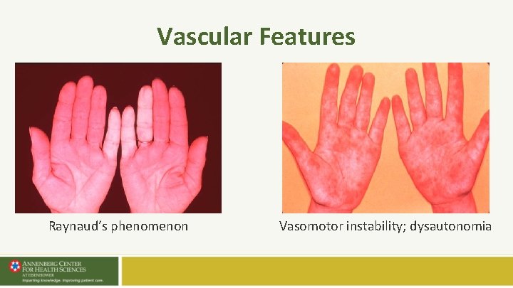 Vascular Features Raynaud’s phenomenon Vasomotor instability; dysautonomia Vascular Features Raynaud’s phenomenon Vasomotor instability; dysautonomia