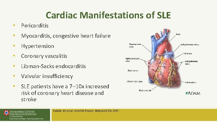 Cardiac Manifestations of SLE • Pericarditis • Myocarditis, congestive heart failure • Hypertension • Cardiac Manifestations of SLE • Pericarditis • Myocarditis, congestive heart failure • Hypertension •