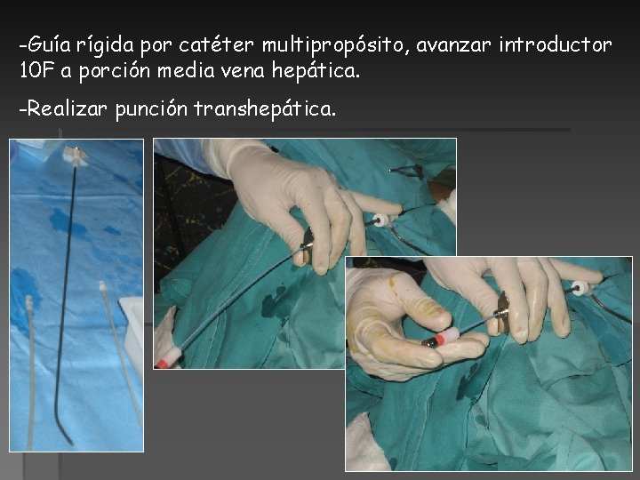 -Guía rígida por catéter multipropósito, avanzar introductor 10 F a porción media vena hepática.
