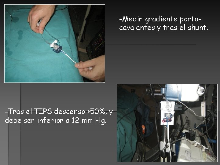 -Medir gradiente portocava antes y tras el shunt. -Tras el TIPS descenso >50%, y