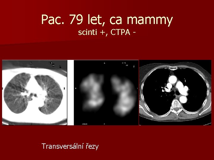 Pac. 79 let, ca mammy scinti +, CTPA - Transversální řezy 