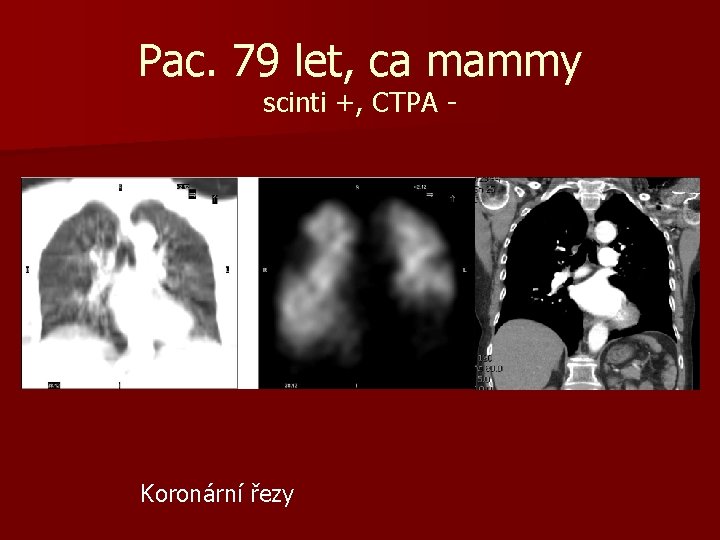 Pac. 79 let, ca mammy scinti +, CTPA - Koronární řezy 