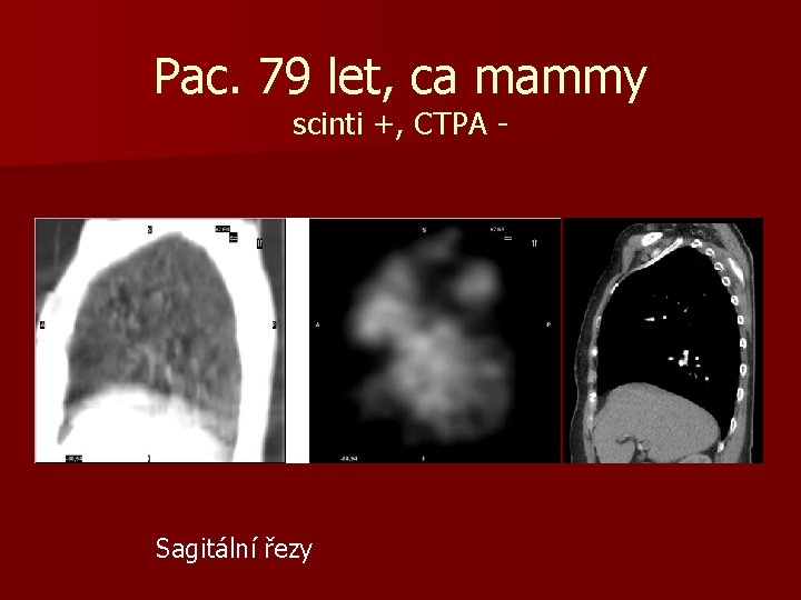 Pac. 79 let, ca mammy scinti +, CTPA - Sagitální řezy 