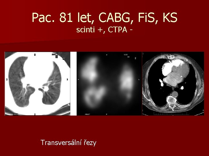 Pac. 81 let, CABG, Fi. S, KS scinti +, CTPA - Transversální řezy 