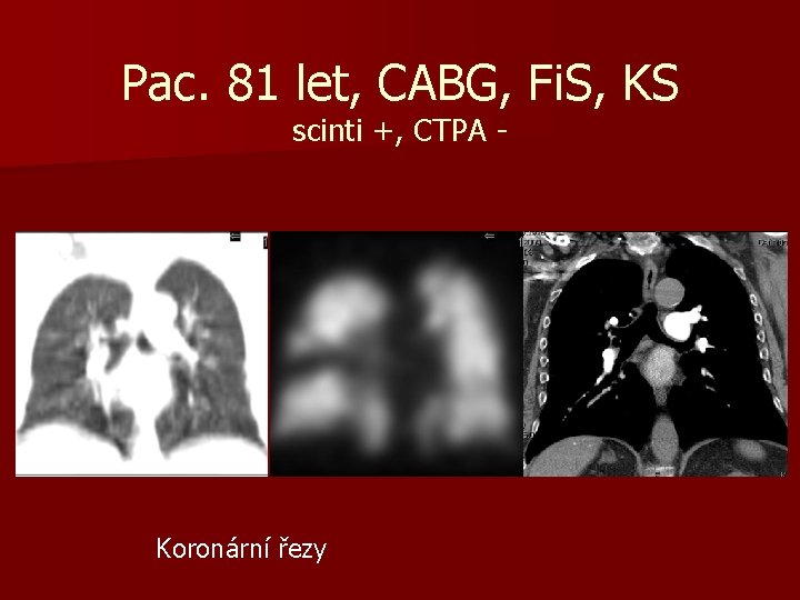 Pac. 81 let, CABG, Fi. S, KS scinti +, CTPA - Koronární řezy 