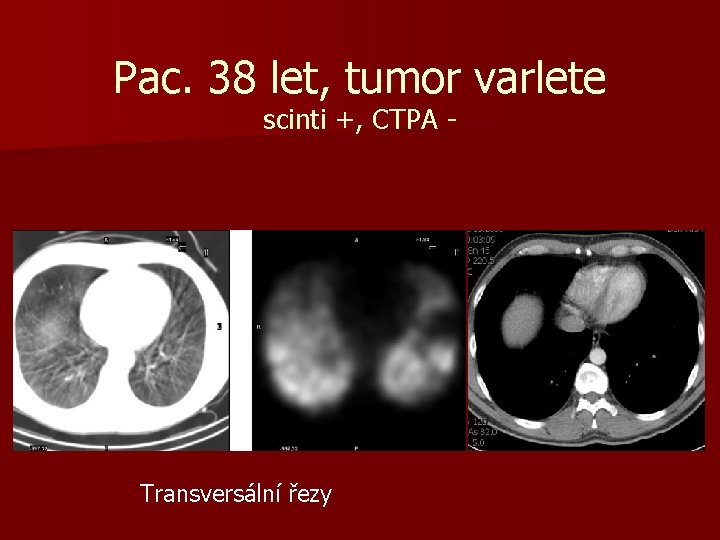 Pac. 38 let, tumor varlete scinti +, CTPA - Transversální řezy 