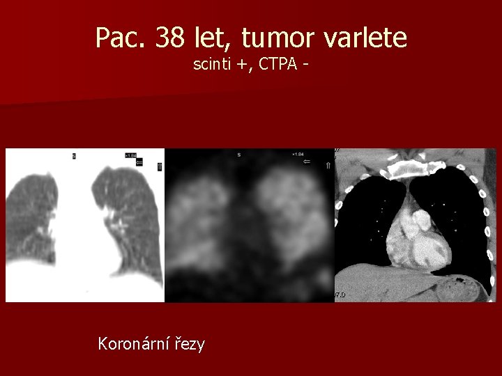 Pac. 38 let, tumor varlete scinti +, CTPA - Koronární řezy 