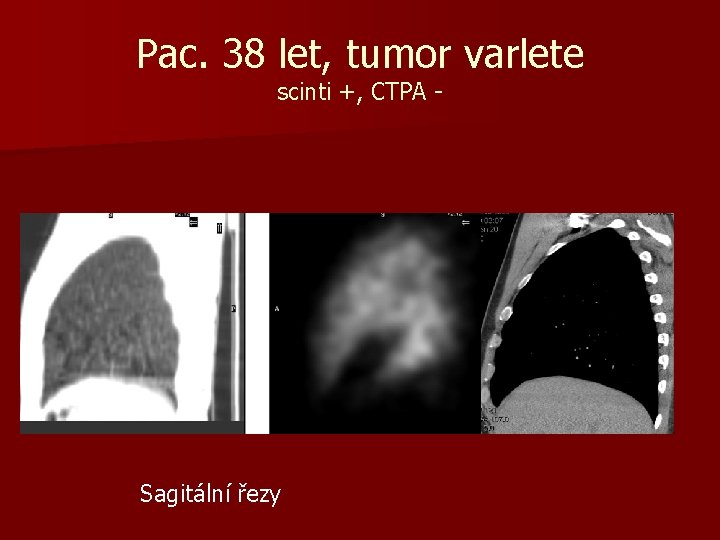 Pac. 38 let, tumor varlete scinti +, CTPA - Sagitální řezy 