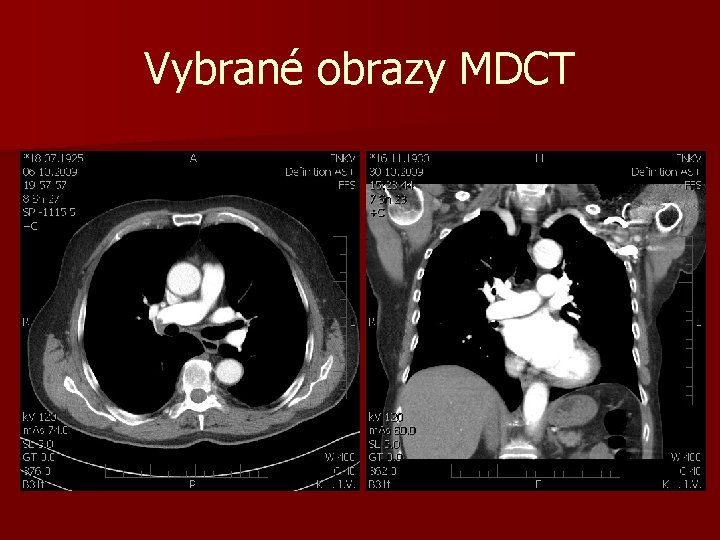 Vybrané obrazy MDCT 