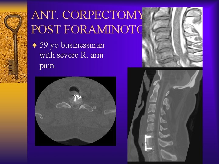 ANT. CORPECTOMY & POST FORAMINOTOMY ¨ 59 yo businessman with severe R. arm pain.