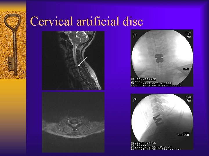 Cervical artificial disc 